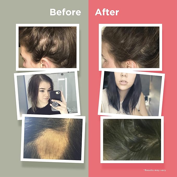 HairAnew Hair Growth Vitamins for Thicker Stronger Hair | Works for Women & Men All Hair Types | 11 Hair Vitamins & Ingredients | 5000mcg Biotin | Vegan | Independently Tested | 60 Capsules (6)